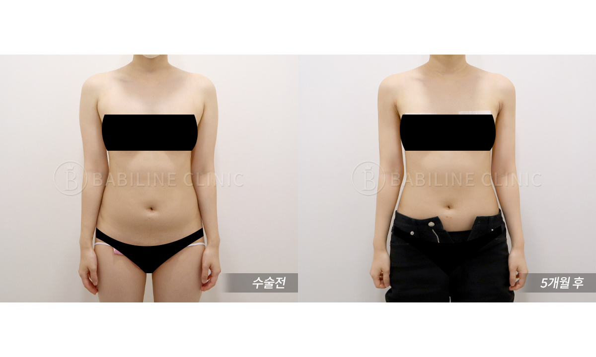 바비라인의원 팔지방흡입[팔+견갑골+쇄골.. 전후사진