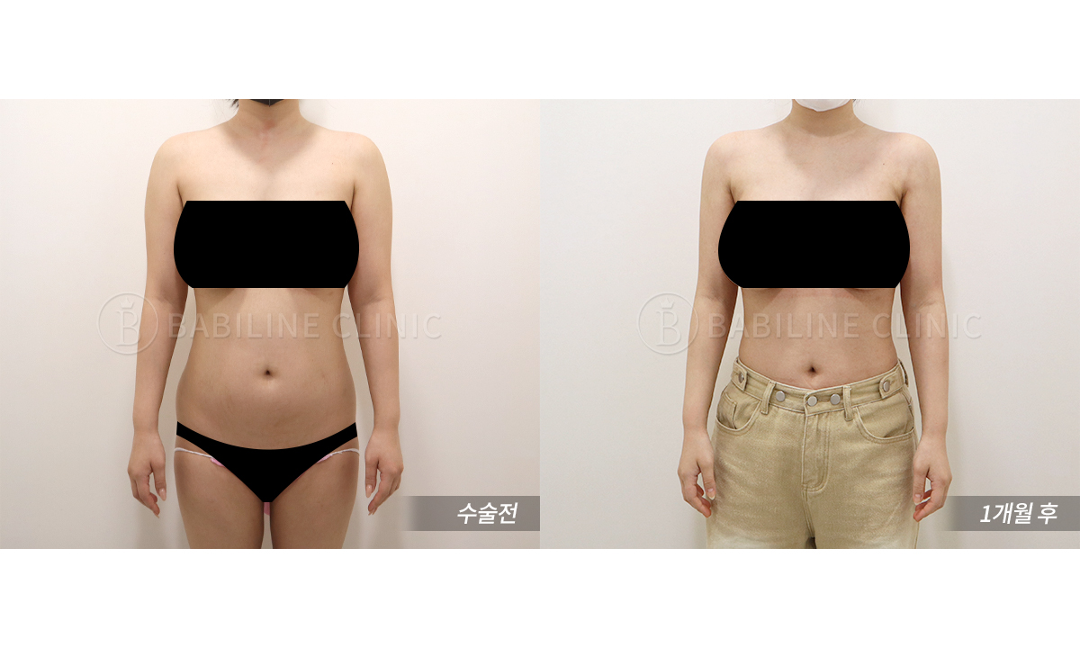 바비라인의원 팔지방흡입 [팔+견갑골+쇄.. 전후사진