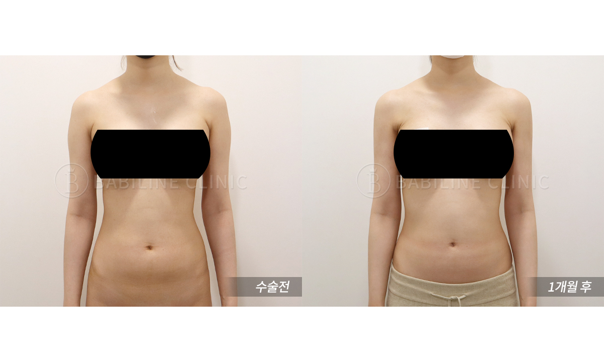 바비라인의원 팔지방흡입[팔+견갑골+브라.. 전후사진