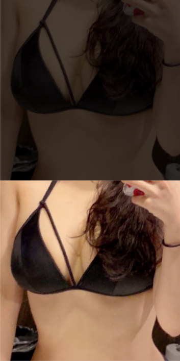 바비라인의원 전후사진